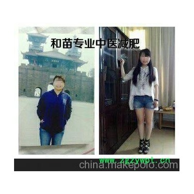 江北和苗供应实惠的和苗针灸综合减肥_大足重庆江北区和苗健康咨询服务部